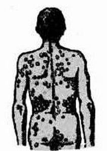 Possible infection scheme