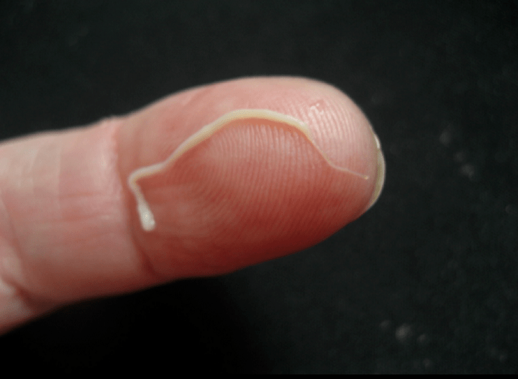 roundworm parasite from the human body